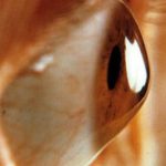 We offer Diagnostic & Therapeutic management of Keratoconus with Custom Made Scleral Lenses which Provides rehabilitation in Vision and stops further progression of keratoconus.