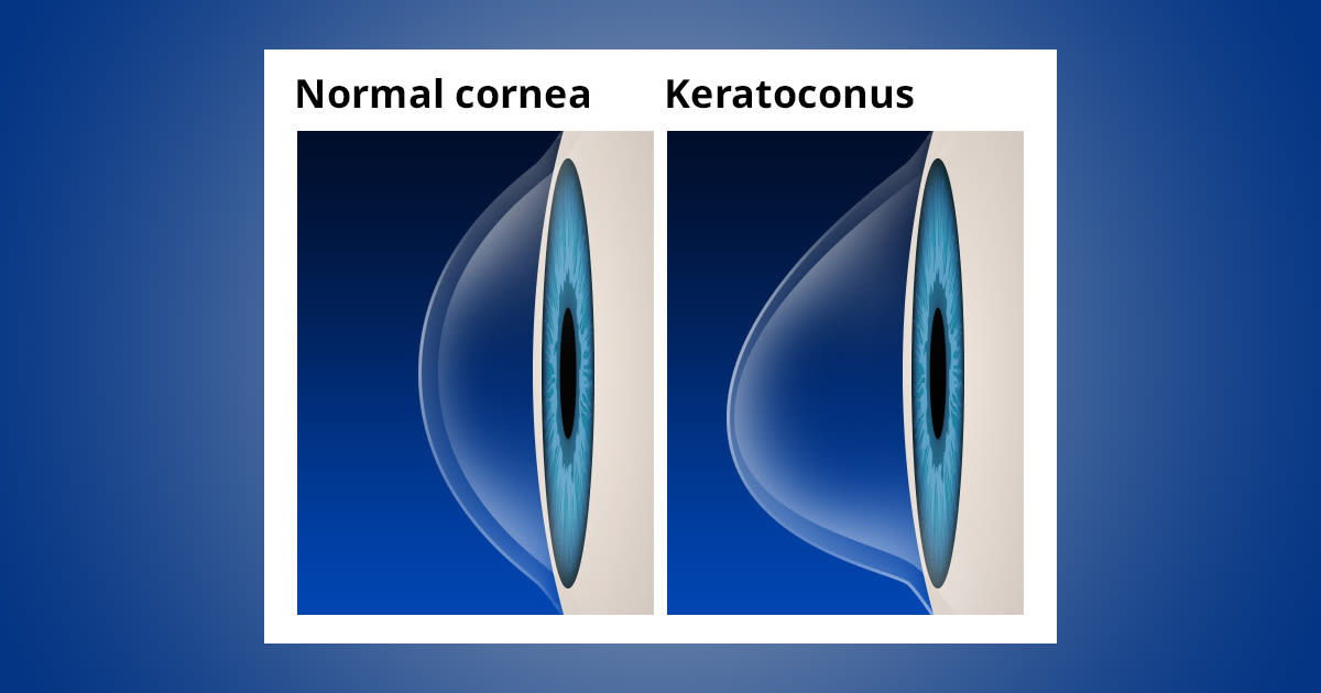 keratoconus